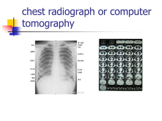 chest radiograph or computer
tomography
 