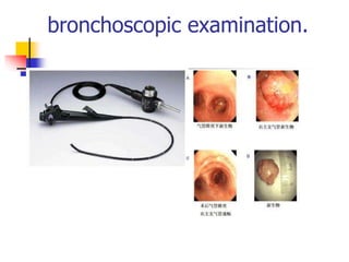 bronchoscopic examination.
 