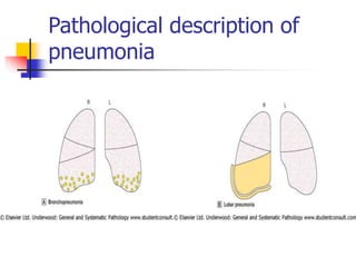Pathological description of
pneumonia
 