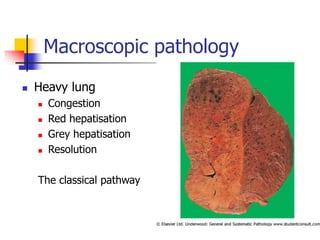 Macroscopic pathology
 Heavy lung
 Congestion
 Red hepatisation
 Grey hepatisation
 Resolution
The classical pathway
 