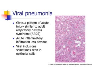 Viral pneumonia
 Gives a pattern of acute
injury similar to adult
respiratory distress
syndrome (ARDS)
 Acute inflammatory
infiltration less obvious
 Viral inclusions
sometimes seen in
epithelial cells
 