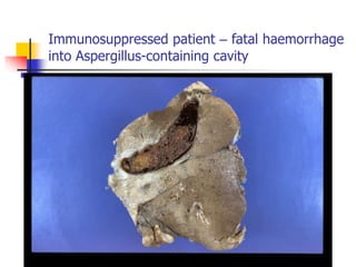Immunosuppressed patient – fatal haemorrhage
into Aspergillus-containing cavity
 