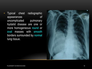 PULMONARY ECHINOCOCCOSIS 14
• Typical chest radiographic
appearances of
uncomplicated pulmonary
hydatid disease are one or
more homogeneous round or
oval masses with smooth
borders surrounded by normal
lung tissue.
 