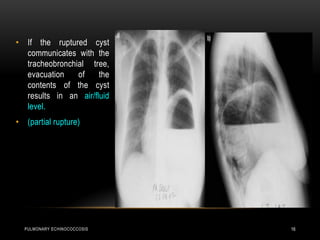 PULMONARY ECHINOCOCCOSIS 16
• If the ruptured cyst
communicates with the
tracheobronchial tree,
evacuation of the
contents of the cyst
results in an air/fluid
level.
• (partial rupture)
 