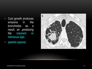 PULMONARY ECHINOCOCCOSIS 17
• Cyst growth produces
erosions in the
bronchioles as a
result, air ,producing
the crescent or
meniscus sign .
• (partial rupture)
 