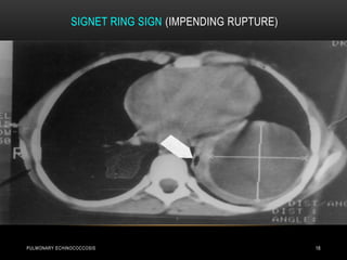 SIGNET RING SIGN (IMPENDING RUPTURE)
18PULMONARY ECHINOCOCCOSIS
 