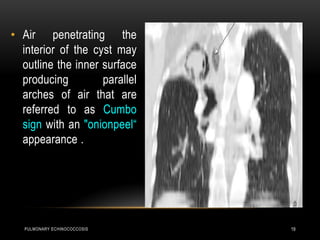 PULMONARY ECHINOCOCCOSIS 19
• Air penetrating the
interior of the cyst may
outline the inner surface
producing parallel
arches of air that are
referred to as Cumbo
sign with an "onionpeel“
appearance .
 