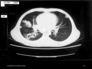 PULMONARY ECHINOCOCCOSIS 20
 