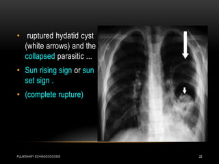 PULMONARY ECHINOCOCCOSIS 22
• ruptured hydatid cyst
(white arrows) and the
collapsed parasitic ...
• Sun rising sign or sun
set sign .
• (complete rupture)
 