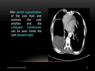 PULMONARY ECHINOCOCCOSIS 23
After partial expectoration
of the cyst fluid and
scolices, the cyst
empties and the
collapsed membranes
can be seen inside the
cyst (serpent sign).
 