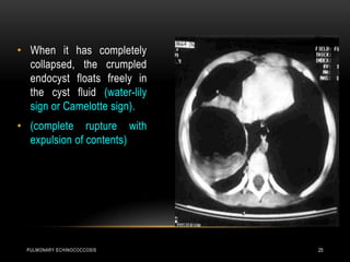 PULMONARY ECHINOCOCCOSIS 25
• When it has completely
collapsed, the crumpled
endocyst floats freely in
the cyst fluid (water-lily
sign or Camelotte sign).
• (complete rupture with
expulsion of contents)
 