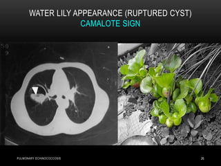 WATER LILY APPEARANCE (RUPTURED CYST)
CAMALOTE SIGN
26PULMONARY ECHINOCOCCOSIS
 