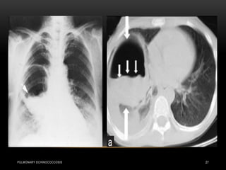 PULMONARY ECHINOCOCCOSIS 27
• Water lilly sign
 