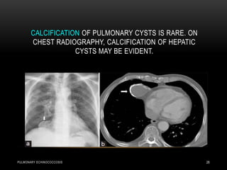 CALCIFICATION OF PULMONARY CYSTS IS RARE. ON
CHEST RADIOGRAPHY, CALCIFICATION OF HEPATIC
CYSTS MAY BE EVIDENT.
PULMONARY ECHINOCOCCOSIS 28
 