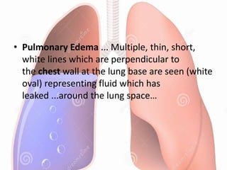 • Pulmonary Edema ... Multiple, thin, short,
white lines which are perpendicular to
the chest wall at the lung base are seen (white
oval) representing fluid which has
leaked ...around the lung space…
 