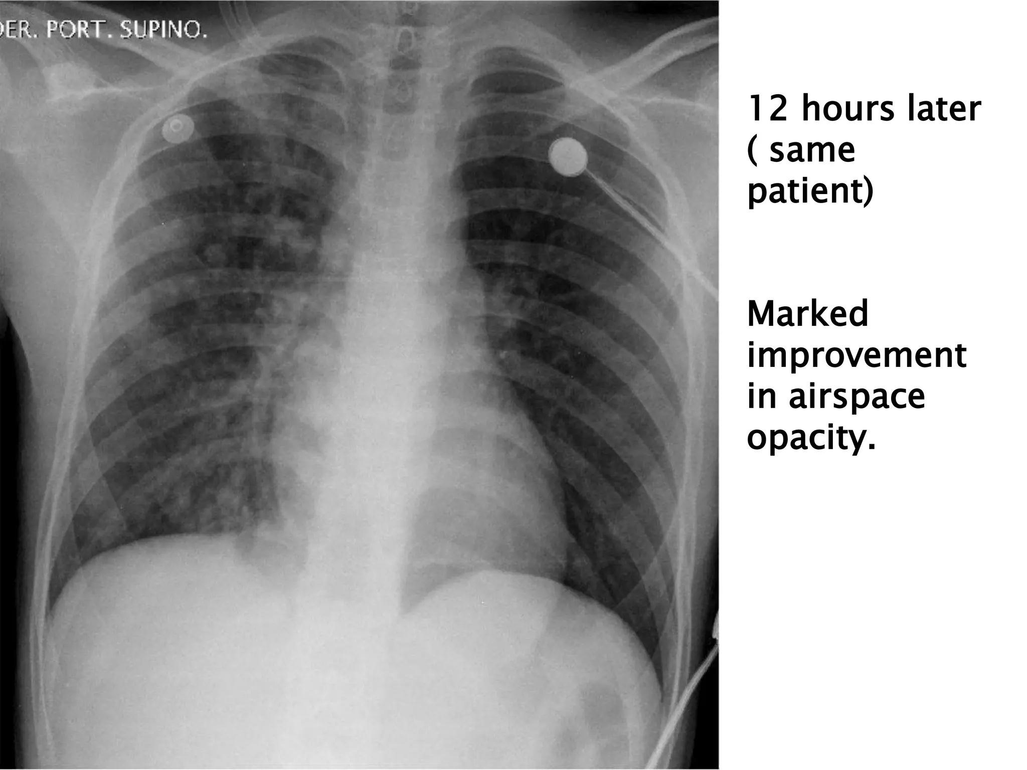 12 hours later
( same
patient)
Marked
improvement
in airspace
opacity.
 