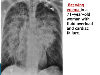 Pulmonary edema | PPTX