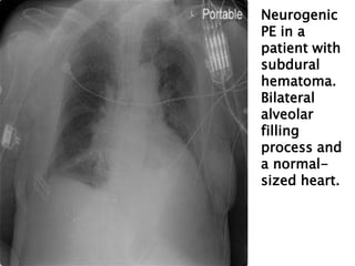 Neurogenic
PE in a
patient with
subdural
hematoma.
Bilateral
alveolar
filling
process and
a normal-
sized heart.
 
