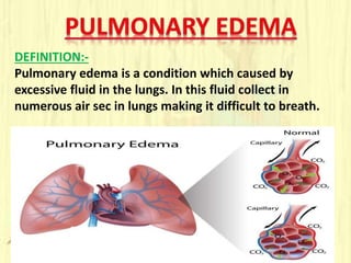 DEFINITION:-
Pulmonary edema is a condition which caused by
excessive fluid in the lungs. In this fluid collect in
numerous air sec in lungs making it difficult to breath.
 