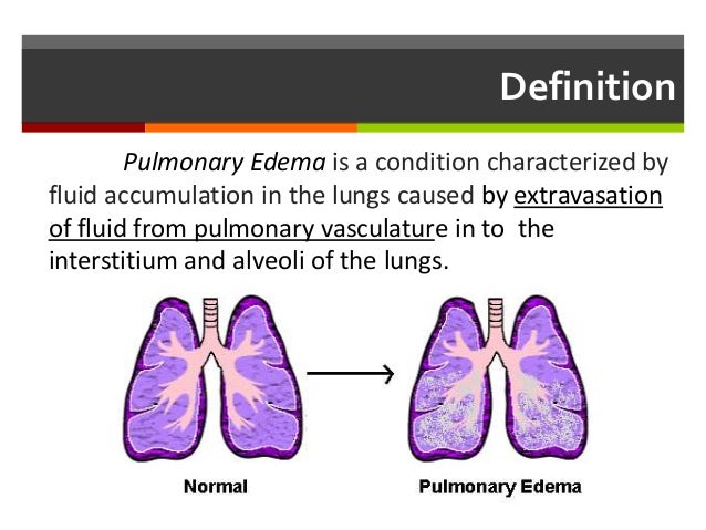 pulmonary oedema pathophysiology approach amp management define pulmonary embolism