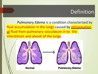 Definition
Pulmonary Edema is a condition characterized by
fluid accumulation in the lungs caused by extravasation
of fluid from pulmonary vasculature in to the
interstitium and alveoli of the lungs.
 
