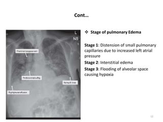 Cont…
 Stage of pulmonary Edema
Stage 1: Distension of small pulmonary
capillaries due to increased left atrial
pressure
Stage 2: Interstitial edema
Stage 3: Flooding of alveolar space
causing hypoxia
8/12/2022 12
 