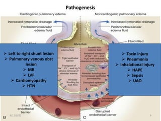 Pathogenesis
 Toxin injury
 Pneumonia
 Inhalational injury
 HAPE
 Sepsis
 UAO
 Left to right shunt lesion
 Pulmonary venous obst
lesion
 MR
 LVF
 Cardiomyopathy
 HTN
8/12/2022 9
 