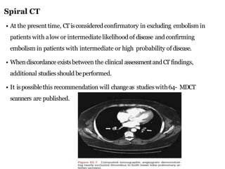 • At the presenttime, CT isconsidered confirmatory in excluding embolism in
patients with alow or intermediate likelihood of disease andconfirming
embolism in patients with intermediate or high probability of disease.
• Whendiscordance existsbetween the clinical assessmentandCT findings,
additional studies should beperformed.
• It ispossiblethis recommendation will changeas studies with64- MDCT
scanners are published.
Spiral CT
 