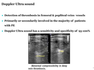 Doppler Ultra sound
33
● Detection of thrombosis in femoral & popliteal veins vessels
● Primarily or secondarily involved in the majority of patients
with PE
● Doppler Ultra sound has a sensitivity and specificity of 95-100%
 