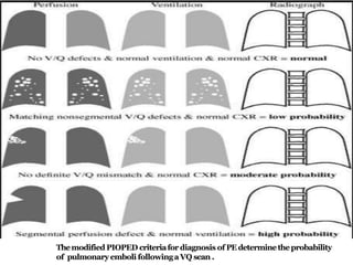 Themodified PIOPED criteriafordiagnosis of PE determinetheprobability
of pulmonary emboli followingaVQ scan .
 