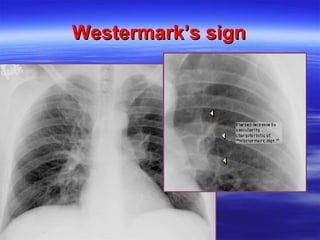 WWeesstteerrmmaarrkk’’ss ssiiggnn 
 