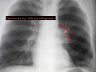 Westermark sign, with hilar enlargement 
 