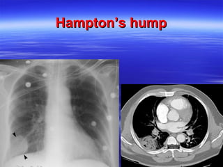 HHaammppttoonn’’ss hhuummpp 
 