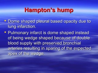 HHaammppttoonn’’ss hhuummpp 
 DDoommee sshhaappeedd pplleeuurraall bbaasseedd ooppaacciittyy dduuee ttoo 
lluunngg iinnffaarrccttiioonn.. 
 PPuullmmoonnaarryy iinnffaarrcctt iiss ddoommee sshhaappeedd iinnsstteeaadd 
ooff bbeeiinngg wweeddggee sshhaappeedd bbeeccaauussee ooff ddoouubbllee 
bblloooodd ssuuppppllyy wwiitthh pprreesseerrvveedd bbrroonncchhiiaall 
aarrtteerriieess rreessuullttiinngg iinn ssppaarriinngg ooff tthhee eexxppeecctteedd 
aappeexx ooff tthhee wweeddggee.. 
 