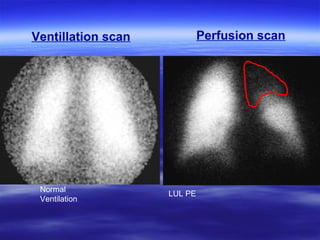 Ventillation scan Perfusion scan 
Normal 
Ventilation LUL PE 
 