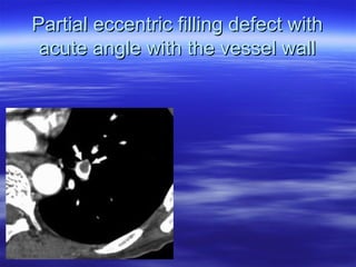 e Partial ecccceennttrriicc ffiilllliinngg ddeeffeecctt wwiitthh 
aaccuuttee aannggllee wwiitthh tthhee vveesssseell wwaallll 
 