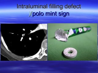 IInnttrraalluummiinnaall ffiilllliinngg ddeeffeecctt 
((((ppoolloo mmiinntt ssiiggnn 
 