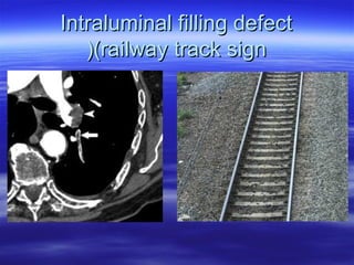 IInnttrraalluummiinnaall ffiilllliinngg ddeeffeecctt 
((((rraaiillwwaayy ttrraacckk ssiiggnn 
 