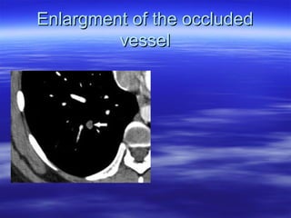 EEnnllaarrggmmeenntt ooff tthhee oocccclluuddeedd 
vveesssseell 
 