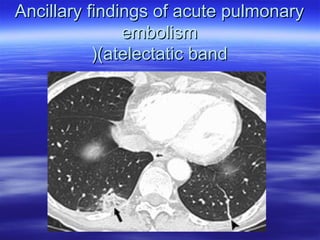 Ancillary findings ooff aaccuuttee ppuullmmoonnaarryy 
eemmbboolliissmm 
((((aatteelleeccttaattiicc bbaanndd 
 
