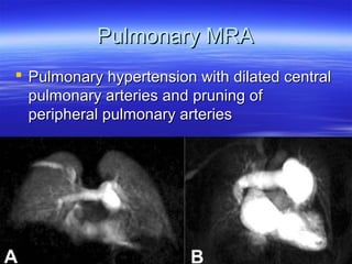 PPuullmmoonnaarryy MMRRAA 
 PPuullmmoonnaarryy hhyyppeerrtteennssiioonn wwiitthh ddiillaatteedd cceennttrraall 
ppuullmmoonnaarryy aarrtteerriieess aanndd pprruunniinngg ooff 
ppeerriipphheerraall ppuullmmoonnaarryy aarrtteerriieess 
 