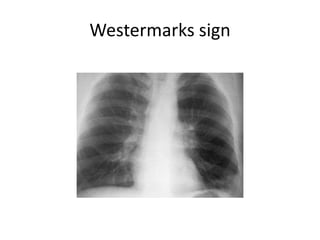 Westermarks sign
 