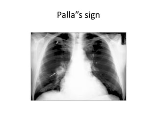Palla”s sign
 