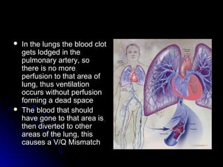  In the lungs the blood clotIn the lungs the blood clot
gets lodged in thegets lodged in the
pulmonary artery, sopulmonary artery, so
there is no morethere is no more
perfusion to that area ofperfusion to that area of
lung, thus ventilationlung, thus ventilation
occurs without perfusionoccurs without perfusion
forming a dead spaceforming a dead space
 The blood that shouldThe blood that should
have gone to that area ishave gone to that area is
then diverted to otherthen diverted to other
areas of the lung, thisareas of the lung, this
causes a V/Q Mismatchcauses a V/Q Mismatch
 