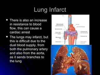 Lung InfarctLung Infarct
 There is also an increaseThere is also an increase
in resistance to bloodin resistance to blood
flow, this can cause aflow, this can cause a
cardiac arrestcardiac arrest
 The lungs may infarct, butThe lungs may infarct, but
this is difficult due to thethis is difficult due to the
dual blood supply, fromdual blood supply, from
both the pulmonary arteryboth the pulmonary artery
and also from the aorta,and also from the aorta,
as it sends branches toas it sends branches to
the lungthe lung
 