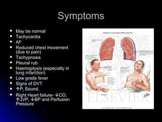 SymptomsSymptoms
 May be normalMay be normal
 TachycardiaTachycardia
 AFAF
 Reduced chest movementReduced chest movement
(due to pain)(due to pain)
 TachypnoeaTachypnoea
 Pleural rubPleural rub
 Haemoptysis (especially inHaemoptysis (especially in
lung infarction)lung infarction)
 Low grade feverLow grade fever
 Signs of DVTSigns of DVT
 PP22 Sound,Sound,
 Right Heart failure-Right Heart failure- CO,CO,
JVP,JVP, BP and PerfusionBP and Perfusion
PressurePressure
 