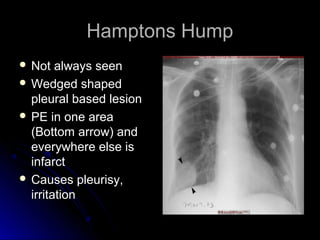 Hamptons HumpHamptons Hump
 Not always seenNot always seen
 Wedged shapedWedged shaped
pleural based lesionpleural based lesion
 PE in one areaPE in one area
(Bottom arrow) and(Bottom arrow) and
everywhere else iseverywhere else is
infarctinfarct
 Causes pleurisy,Causes pleurisy,
irritationirritation
 