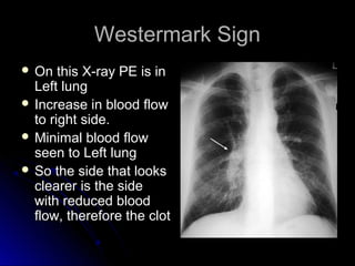 Westermark SignWestermark Sign
 On this X-ray PE is inOn this X-ray PE is in
Left lungLeft lung
 Increase in blood flowIncrease in blood flow
to right side.to right side.
 Minimal blood flowMinimal blood flow
seen to Left lungseen to Left lung
 So the side that looksSo the side that looks
clearer is the sideclearer is the side
with reduced bloodwith reduced blood
flow, therefore the clotflow, therefore the clot
 