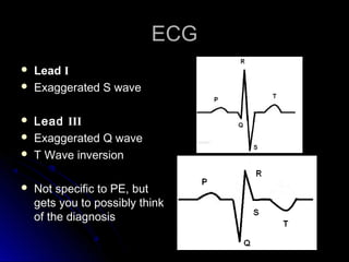 ECGECG
 LeadLead II
 Exaggerated S waveExaggerated S wave
 LeadLead IIIIII
 Exaggerated Q waveExaggerated Q wave
 T Wave inversionT Wave inversion
 Not specific to PE, butNot specific to PE, but
gets you to possibly thinkgets you to possibly think
of the diagnosisof the diagnosis
 