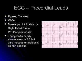 ECG – Precordial LeadsECG – Precordial Leads
 Peaked T wavesPeaked T waves
 V1-V4V1-V4
 Makes you think about :-Makes you think about :-
Right Heart Strain,Right Heart Strain,
PE, Cor-pulmonalePE, Cor-pulmonale
 Tachycardia nearlyTachycardia nearly
always seen in PE butalways seen in PE but
also most other problemsalso most other problems
so non-specificso non-specific
 
